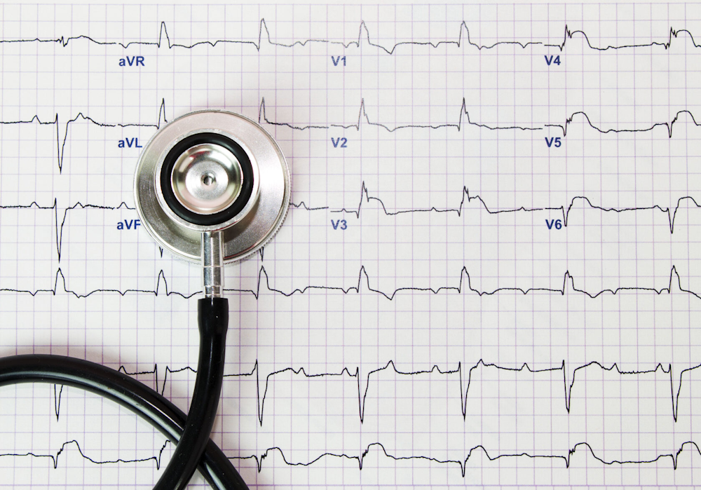 A stethoscope rests on an electrocardiogram (ECG) chart displaying heart rhythms.